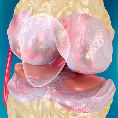 Arizona Knee Pain Solutions photo 4