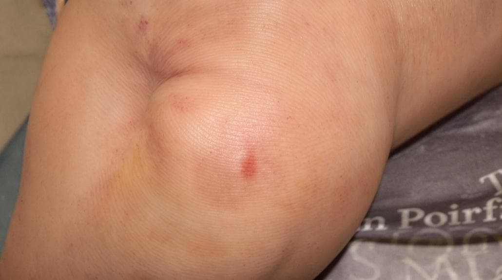 meniscus tear symptom identification